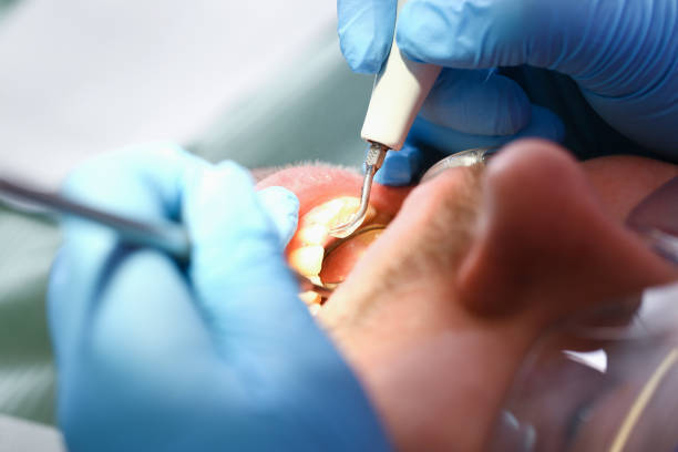 Best Emergency Tooth Extraction in San Marino, CA